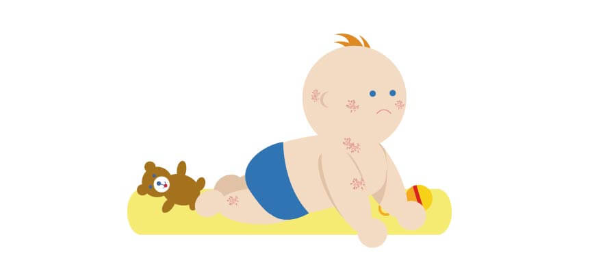 Illustration d’un bébé atteint d’eczéma
